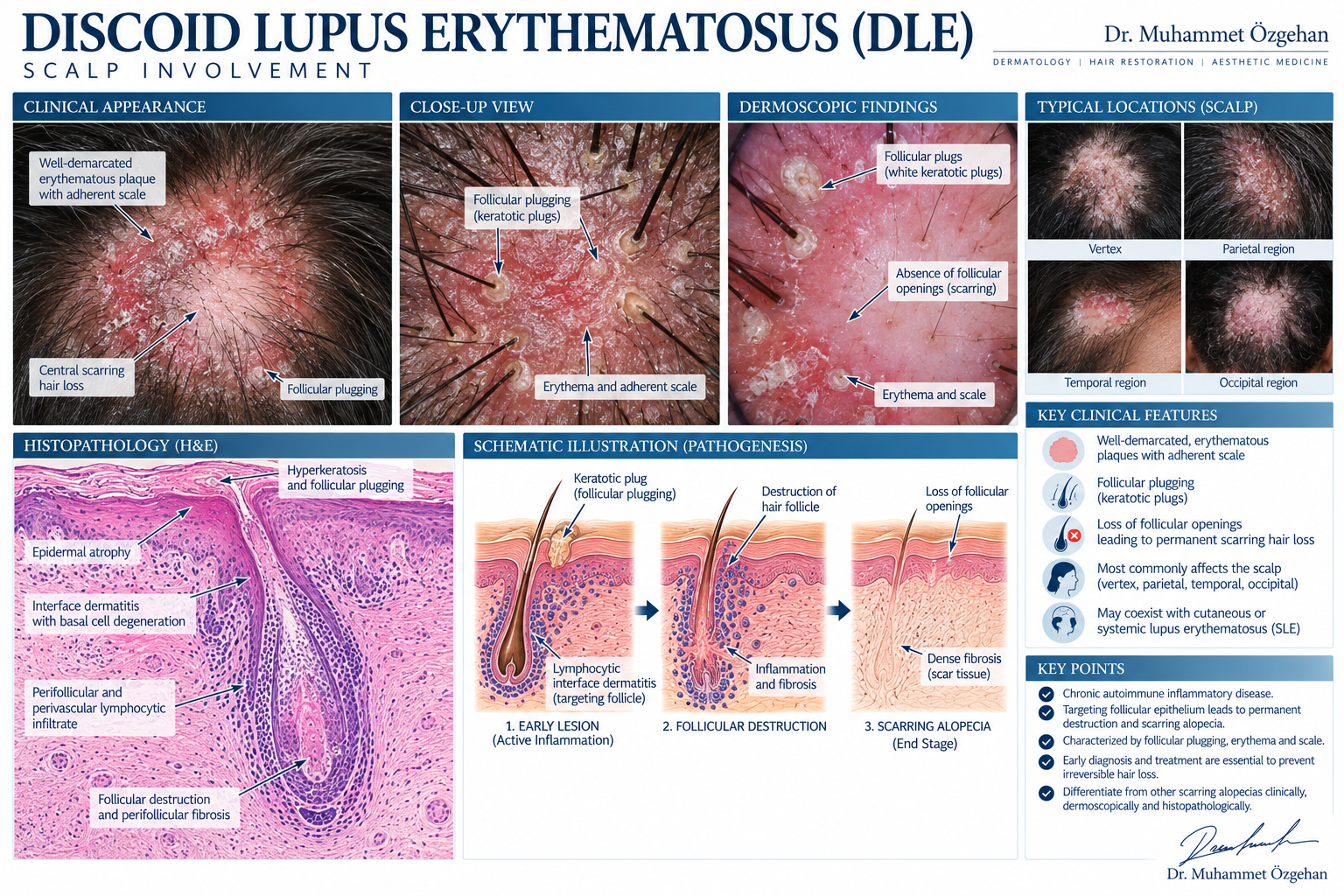 Diskoid Lupus Eritematozus – DLE 2 Diskoid Lupus Eritematozus DLE Klinik ve Medikal İllüstrasyonu
