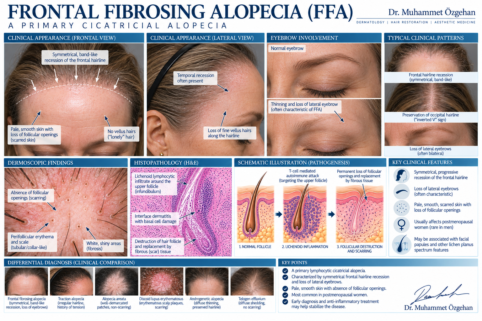 Frontal Fibrozan Alopesi FFA Saç Dökülmesi Klinik ve Medikal İllüstrasyonu