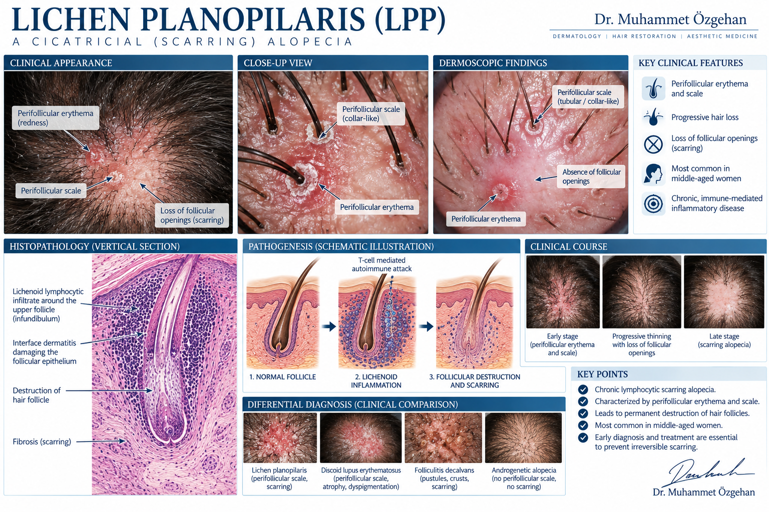 Liken Planopilaris (LPP) 2 Liken Planopilaris LPP Saç Dökülmesi Klinik ve Medikal İllüstrasyonu